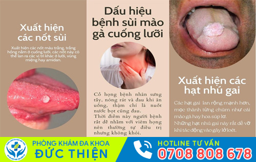 Hình ảnh sùi mào gà ở lưỡi
