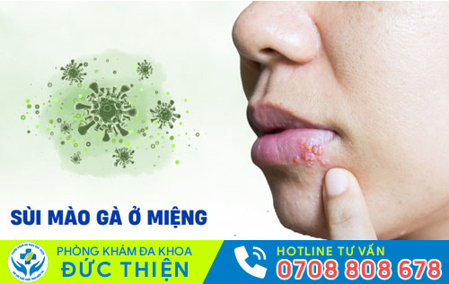 Sùi mào gà ở miệng