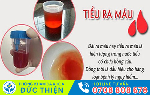 Nguyên nhân gây tiểu buốt ra máu
