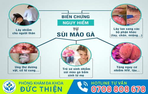 Tự điều trị sùi mào gà tại nhà có hiệu quả?