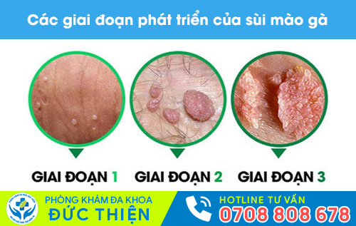 Sùi mào gà ở nam giới