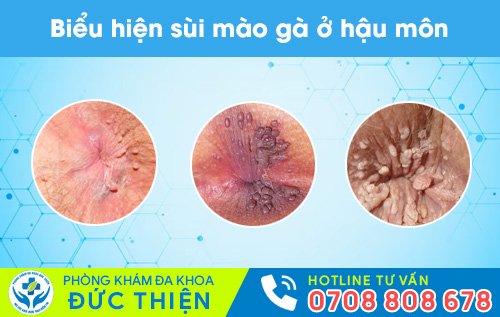Sùi mào gà ở hậu môn