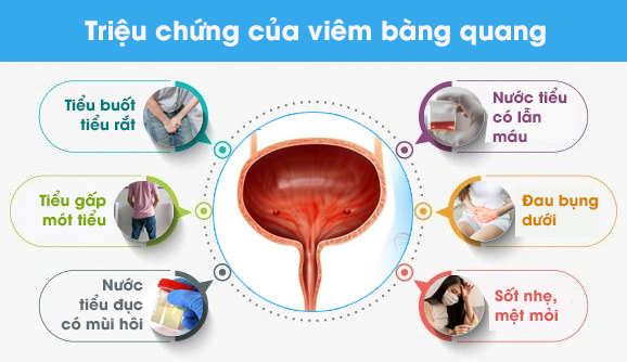Triệu chứng của viêm bàng quang