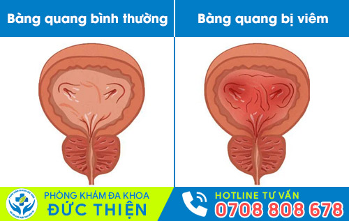 Viêm bàng quang